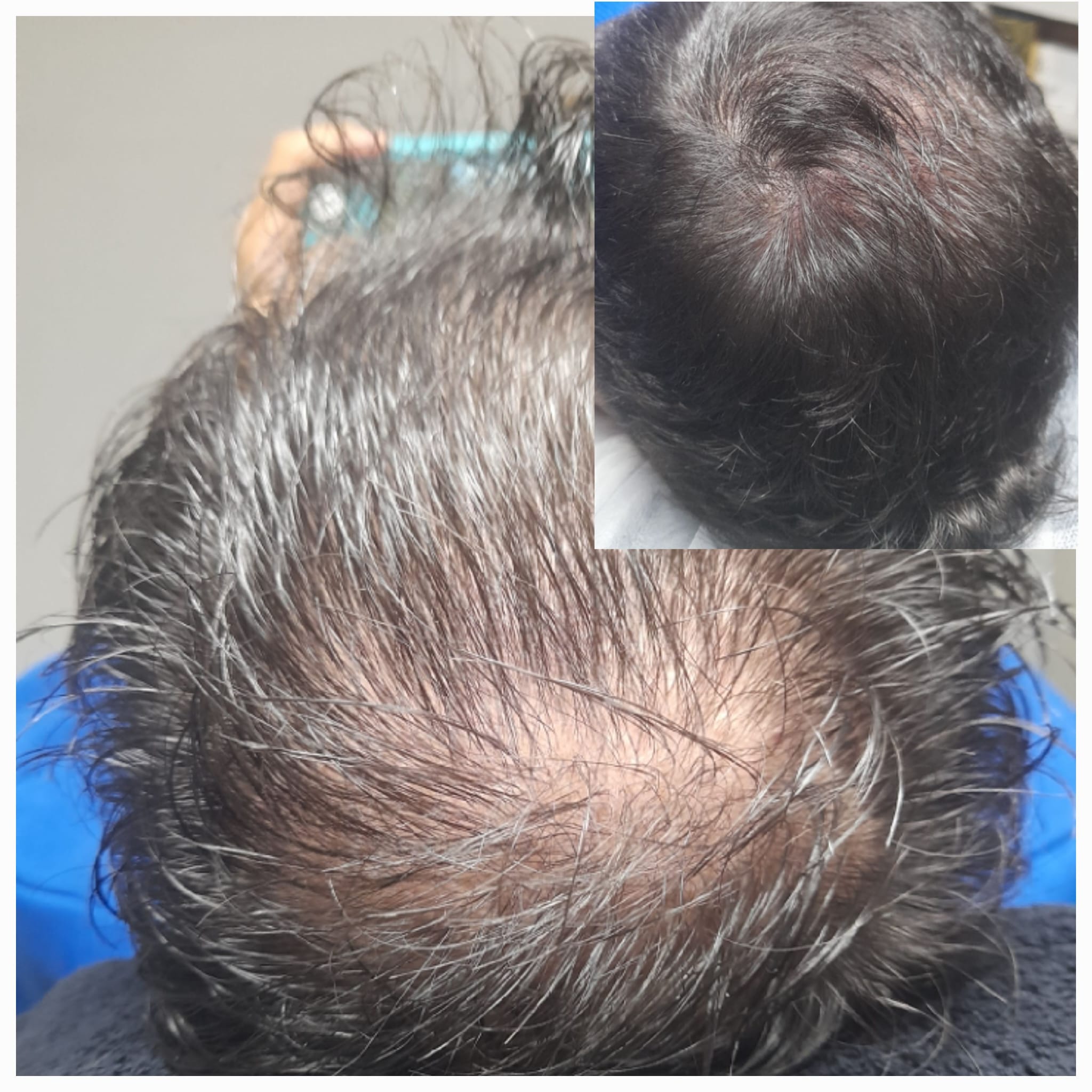 Tricopigmentación Capilar